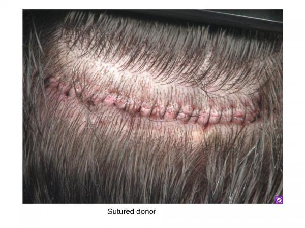 sutured donor1