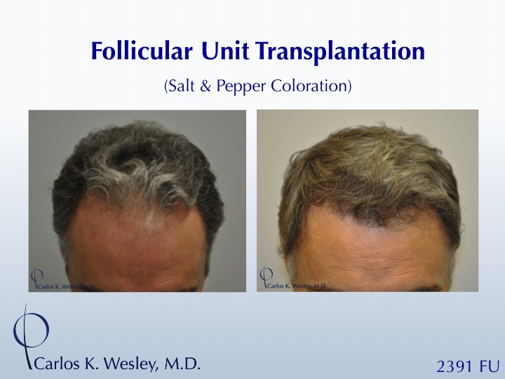 This patient is seen Before/After a 2391 graft 
session with Carlos K. Wesley, M.D. 
 
An interactive Before/After image of this patient can be...