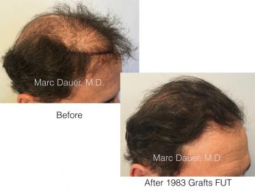 patient hair transplant result of Marc Dauer, MD