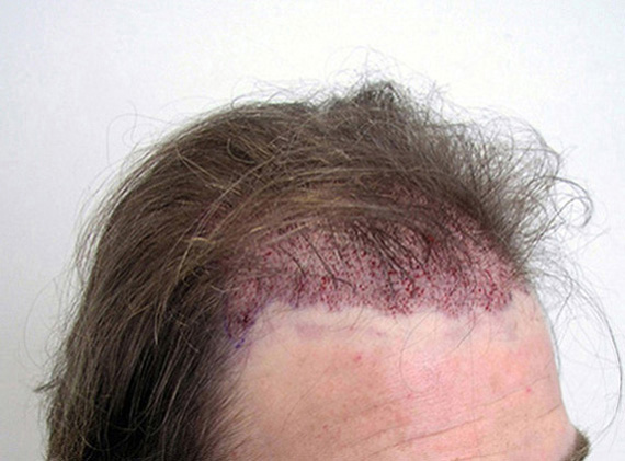 IMMEDIATELY AFTER 1630 FOLLICULAR UNITS PLACED