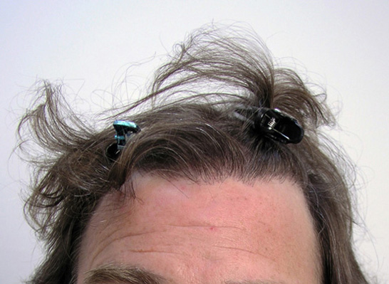 HAIRLINE CLOSEUP