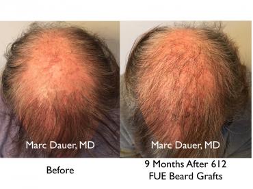 Click image for larger version

Name:	Hair Transplant Slides copy24.004.jpg

Size:	19.0 KB
ID:	44794