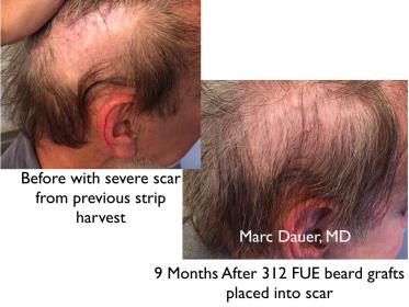 Click image for larger version

Name:	Hair Transplant Slides copy24.005.jpg

Size:	19.2 KB
ID:	44795