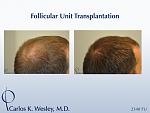 This 25-year-old patient had tried finasteride 1mg (Propecia) prior to his decision to treat his thinning mid scalp with surgical hair restoration....
