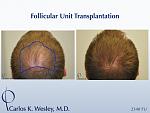 An outline of the mid scalp region treated. 
 
An interactive before/after image of this patient can be viewed here:...