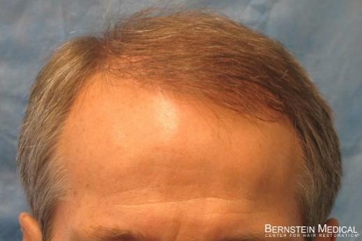 Click image for larger version

Name:	04_after-2nd-hair-transplant.jpg

Size:	21.0 KB
ID:	42614