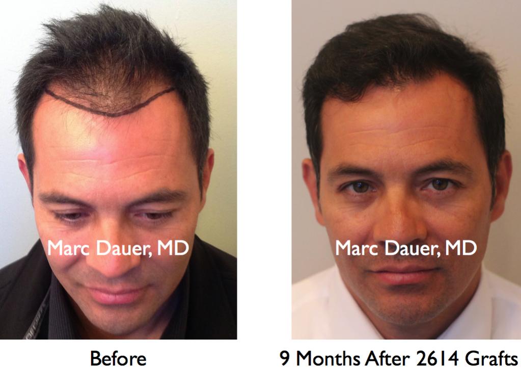 Click image for larger version

Name:	Hair Transplant Slides5.213.jpg

Size:	69.8 KB
ID:	34103