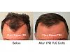 Click image for larger version

Name:	Hair Transplant Slides copy52.001.jpg

Size:	13.6 KB
ID:	46703