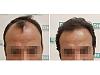 43 years old, 4338 hairs implanted, see 6 months result.