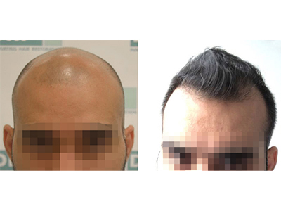 ankur sharma, 5000 hairs implanted. See 10 months result.
