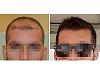 Hairs implanted 2315. See 9 months result.