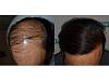 Mr Anoop Kumar 58 years old 6500 hair result