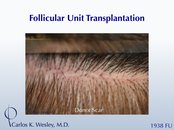 This patient presented to Dr. Carlos K. Wesley for a repair of work performed many years prior at a different clinic.  A video of his transformation...