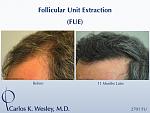 Follicular Unit Extraction (FUE) with Dr. Carlos K. Wesley in New York City. Before/After 2701 FUE grafts using a combination of 0.8mm and 0.9mm...