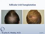 This 22-year-old can be seen before/after a 2265 grafts session to his mid scalp with Dr. Carlos K. Wesley 
 
An interactive before/after image of...