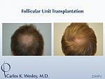 This 22-year-old can be seen before/after a 2265 grafts session to his mid scalp with Dr. Carlos K. Wesley 
 
An interactive before/after image of...
