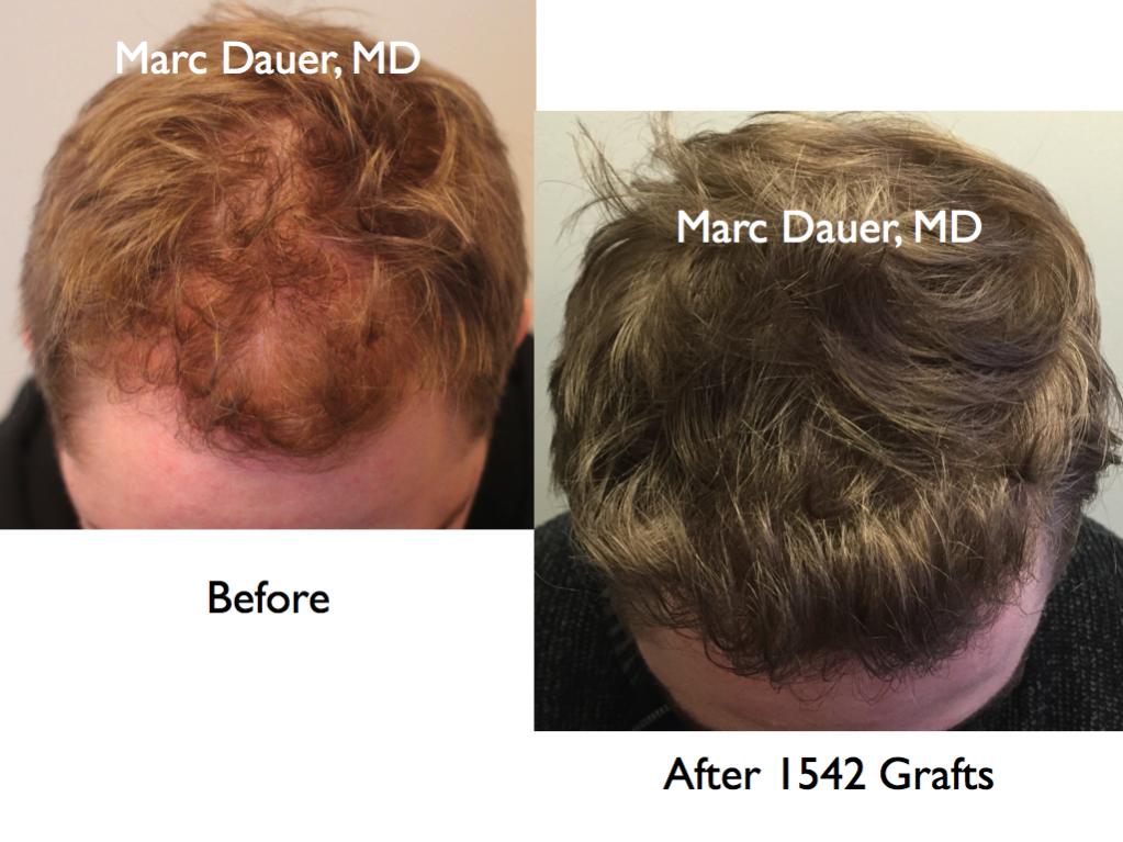 Click image for larger version

Name:	Hair Transplant Slides5.384.jpg

Size:	86.0 KB
ID:	36622