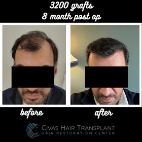 Procedure: FUE Hair Transplant 
Number of grafts: 3200 Grafts 
Results: 8 Months Post-op