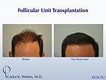 A 42-year-old man had two (2) prior hair transplants with poor results.  He came to Dr. Carlos K. Wesley (NYC) for a repair to create a more natural...