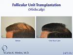 A 42-year-old man had two (2) prior hair transplants with poor results.  He came to Dr. Carlos K. Wesley (NYC) for a repair to create a more natural...