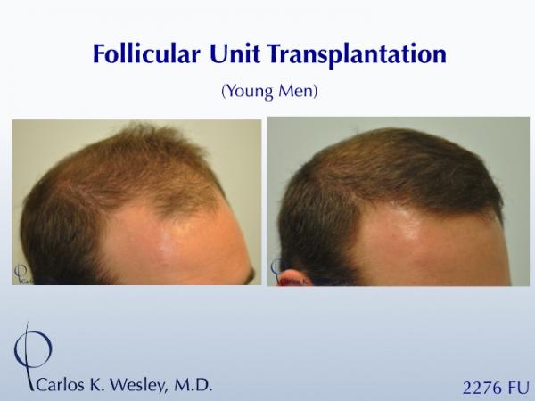 This 28-year-old desired the most natural appearing surgical hair restoration. He elected to have a session with Dr. Carlos K. Wesley in New York...