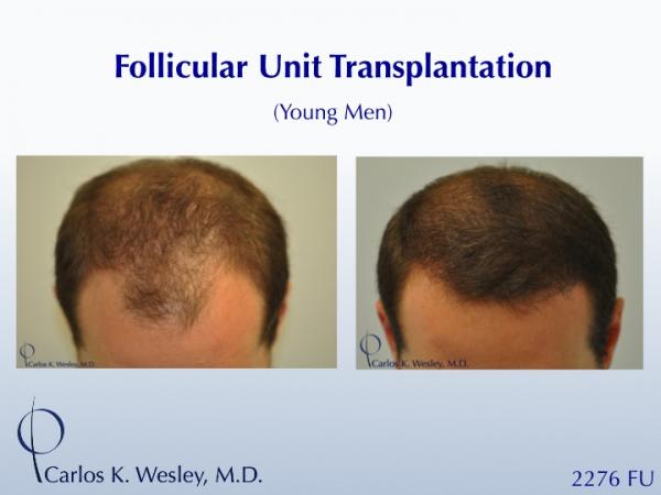 This 28-year-old desired the most natural appearing surgical hair restoration. He elected to have a session with Dr. Carlos K. Wesley in New York...