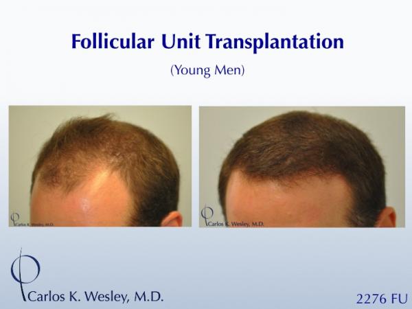 This 28-year-old desired the most natural appearing surgical hair restoration. He elected to have a session with Dr. Carlos K. Wesley in New York...