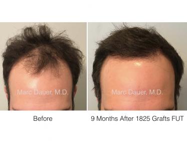 1825 Grafts FUT by Dr. Marc Dauer