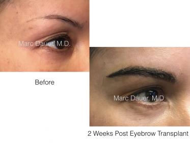 eyebrow transplant photos of a patient of Dr. Marc Dauer