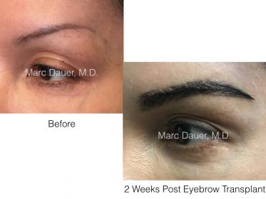 eyebrow transplant photos of a patient of Dr. Marc Dauer