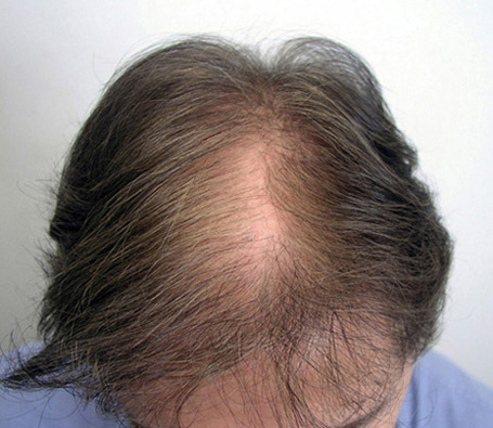 Before hair transplantation