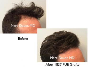 Click image for larger version

Name:	Hair Transplant Slides copy229.006.jpg

Size:	12.2 KB
ID:	49063