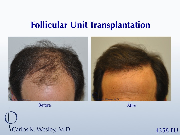 This patient's session with Carlos K. Wesley, M.D. (NYC) addressed both the frontal and mid scalp portions of his scalp.