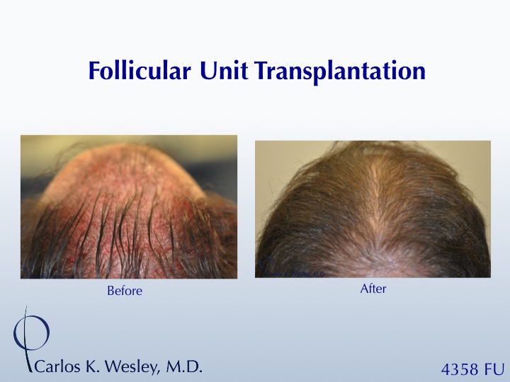 This patient's session with Carlos K. Wesley, M.D. (NYC) addressed both the frontal and mid scalp portions of his scalp.