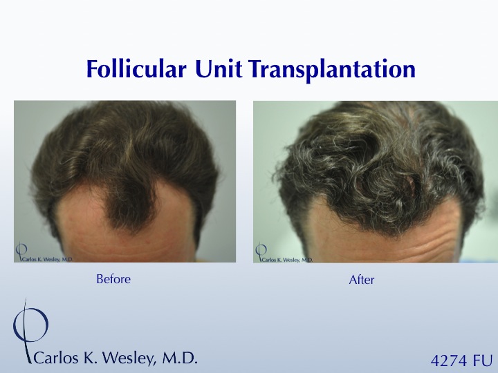 Before/After images of this 50-yr-old patient after a 4250-graft treatment by Dr. Carlos K. Wesley.  A video of his transformation may be viewed at...