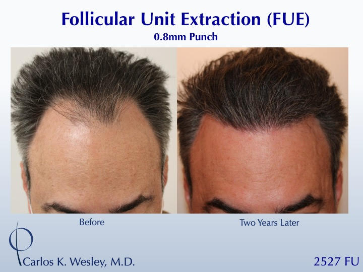 52-year-old man underwent a follicular unit extraction(FUE) session with Dr. Carlos K. Wesley in which a total of 2527 
 
CARLOS K. WESLEY, MD (NYC)...