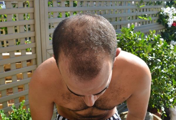 KD Front On Down 15022012 
Pre FUE Hair Transplant Dr Woods 
www.fuehairtransplanttruth.com