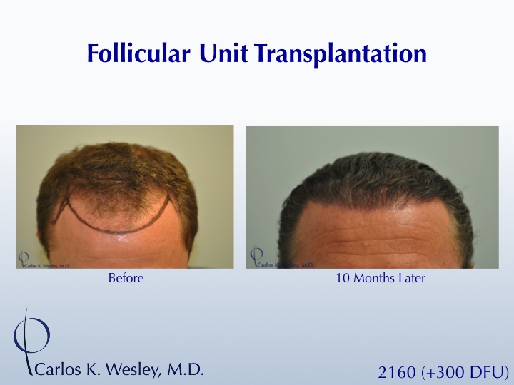 A 40-year-old male underwent a 2460 FU session of FUT with Dr. Carlos K. Wesley (NYC).