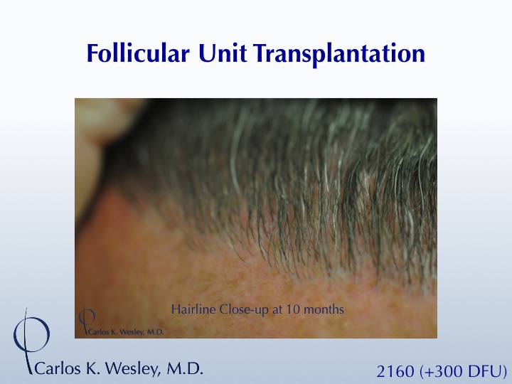 A 40-year-old male underwent a 2460 FU session of FUT with Dr. Carlos K. Wesley (NYC).