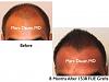 Click image for larger version

Name:	Hair Transplant Slides.515.jpg

Size:	33.1 KB
ID:	38199