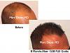 Click image for larger version

Name:	Hair Transplant Slides.517.jpg

Size:	35.1 KB
ID:	38201