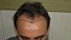 Click image for larger version

Name:	Darling Buds Clinic hair transplant pre op 2.jpg

Size:	91.2 KB
ID:	55396