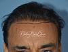Click image for larger version

Name:	Darling Buds Clinic hair transplant post op 2.jpg

Size:	91.0 KB
ID:	55400