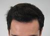 Click image for larger version

Name:	hair transplant 7 mos post 4.jpg

Size:	82.2 KB
ID:	42718