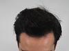 Click image for larger version

Name:	hair transplant 7 mos post 5.jpg

Size:	85.7 KB
ID:	42719