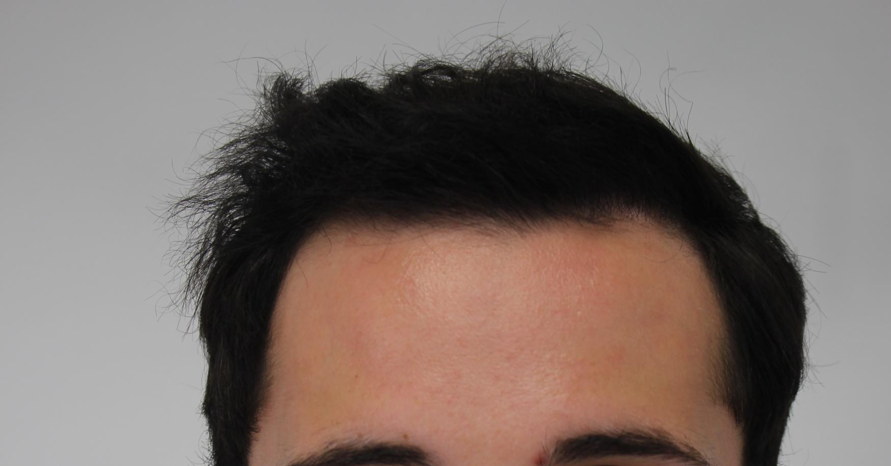 Click image for larger version

Name:	hair transplant 7 mos post 1.jpg

Size:	85.9 KB
ID:	42728