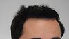 Click image for larger version

Name:	hair transplant 7 mos post 3.jpg

Size:	83.1 KB
ID:	42730