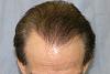 Click image for larger version

Name:	06_immediately-after-2nd-hair-transplant-top-view.jpg

Size:	50.5 KB
ID:	12698