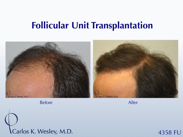 This patient's session with Carlos K. Wesley, M.D. (NYC) addressed both the frontal and mid scalp portions of his scalp.