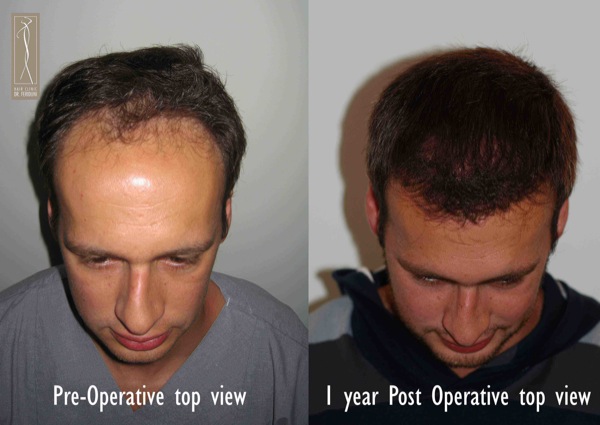 Click image for larger version

Name:	Patient 1 - pre and post top view.jpg

Size:	63.7 KB
ID:	4798